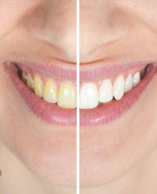 Zahnarzt Nekzai sorgt mit Bleaching in Hamburg Wandsbek für strahlend weiße Zähne