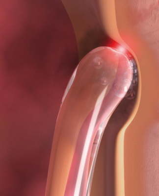 biolitec präsentiert Urologie-Laser LEONARDO DUAL 200 auf der EAU 2023 in Mailand: Multipler Einsatz bei Prostata-, Blase- und Nieren-OP