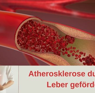 Atherosklerose durch die Leber gefördert
