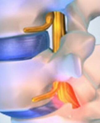 Woran erkennt man Wirbelgleiten, und wie wird es behandelt?