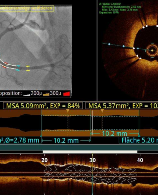 Kardiologie in Siegen: Was sind komplexe Koronarinterventionen?