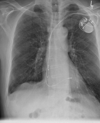 Kardiologie: Fakten zur minimalinvasiven Herzklappenintervention