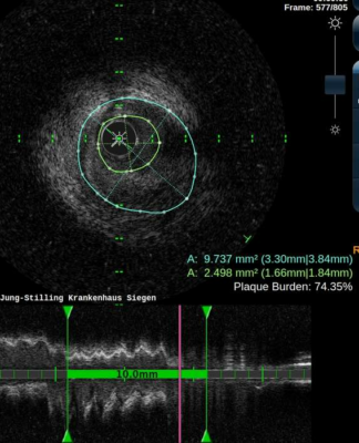 Kardiologie: Studie vergleicht CTO und OMT