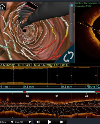 Kardiologie: Mitraclip-Patienten brauchen enge Nachsorge