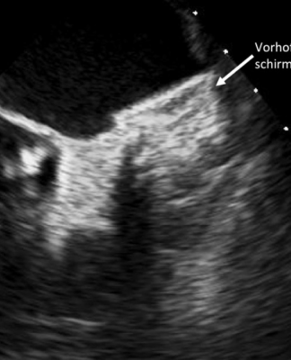 Vorhofflimmerablation oder abwarten – Kardiologe informiert
