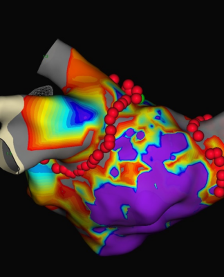Herzrhythmusstörungen: Neue Leitlinie in der Kardiologie