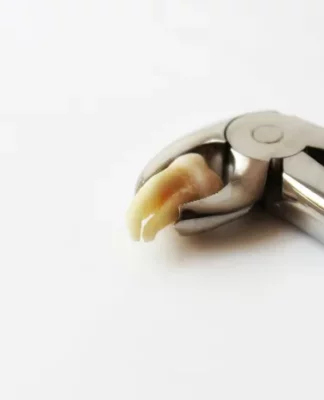 Weisheitszähne entfernen? Ja oder Nein!