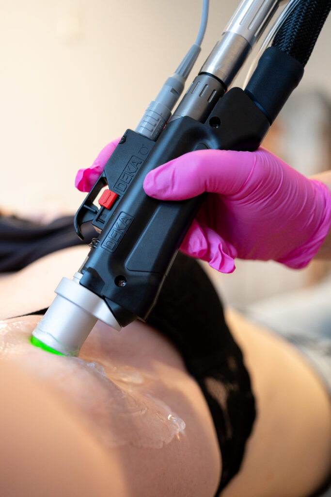 Sommer 2025 - Haut, die du zeigen willst 1 2 IMPULSE Moveo Deka 4 Haarentfernung Laser